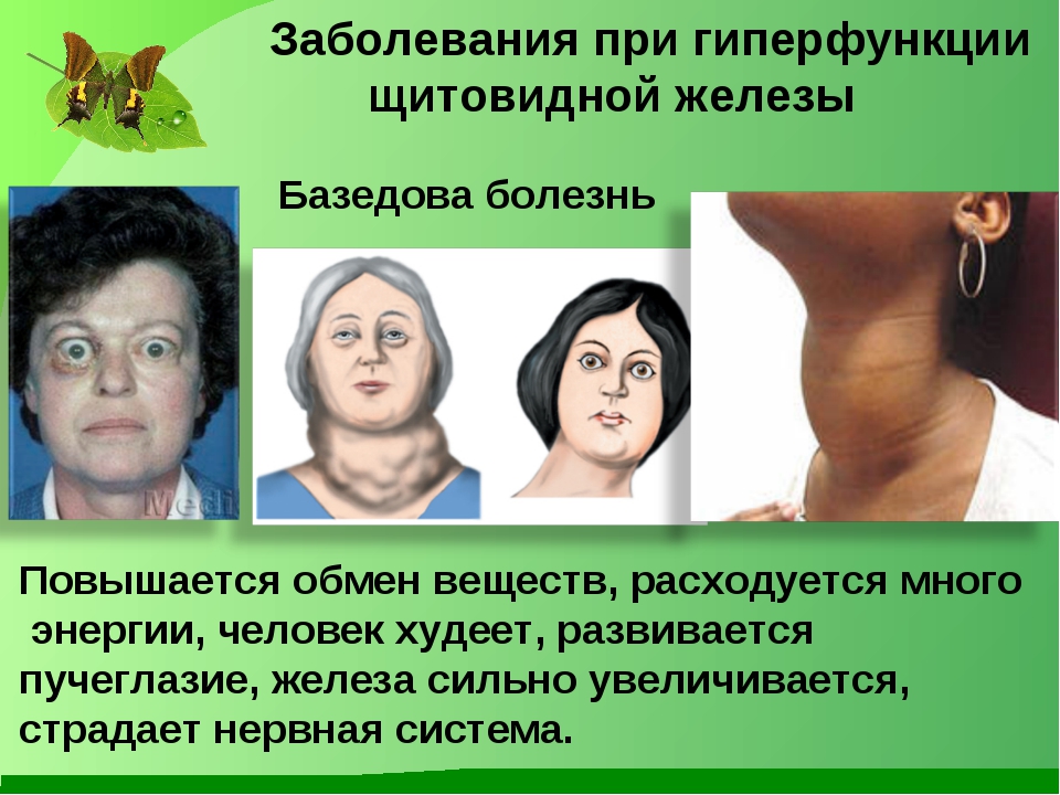 Щитовидная железа: гиперфункция патологическая и физиологическая 1 – Студенты России